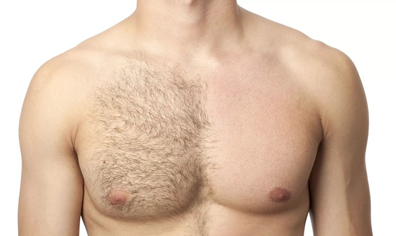 épilation homme